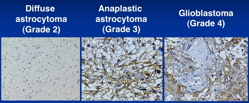 astrocytoma