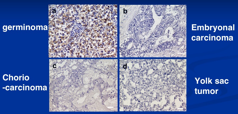 germinoma-2