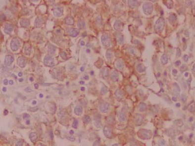 seminoma